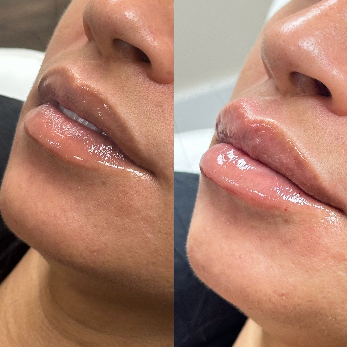 FILLERS